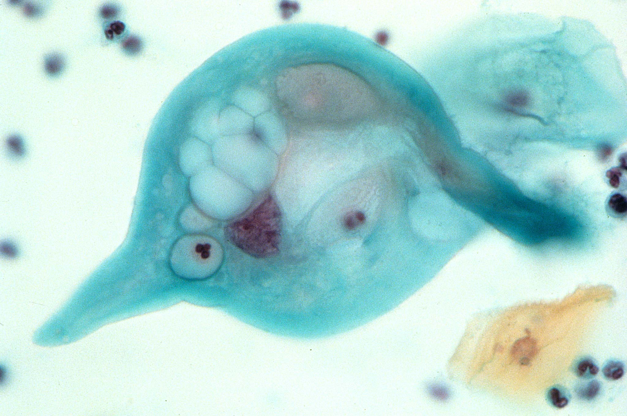 Cervico Vaginal Smear Showing An Abnormal Epithelial Cell Exhibiting