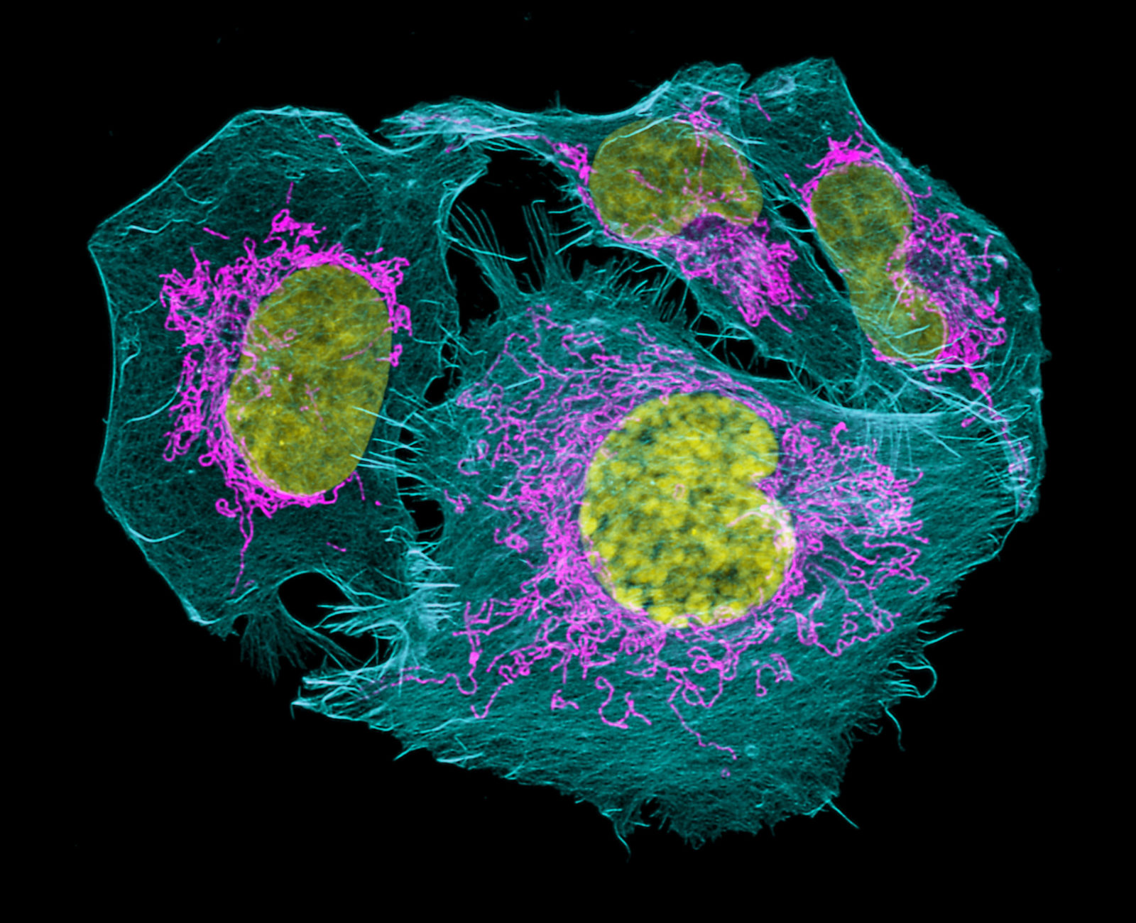 Prostate cancer cells | Nikon’s Small World